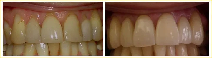 Smile Makeover in Athens - TLC Dental Wellness