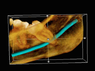 Wisdom Tooth Structure ─ Baton Rouge, LA ─ Rabel Family Dentistry