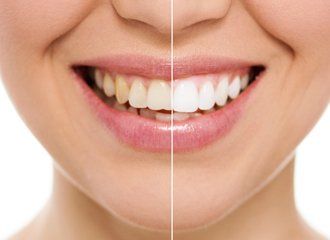 Before and After Teeth Cleaning ─ Baton Rouge, LA ─ Rabel Family Dentistry