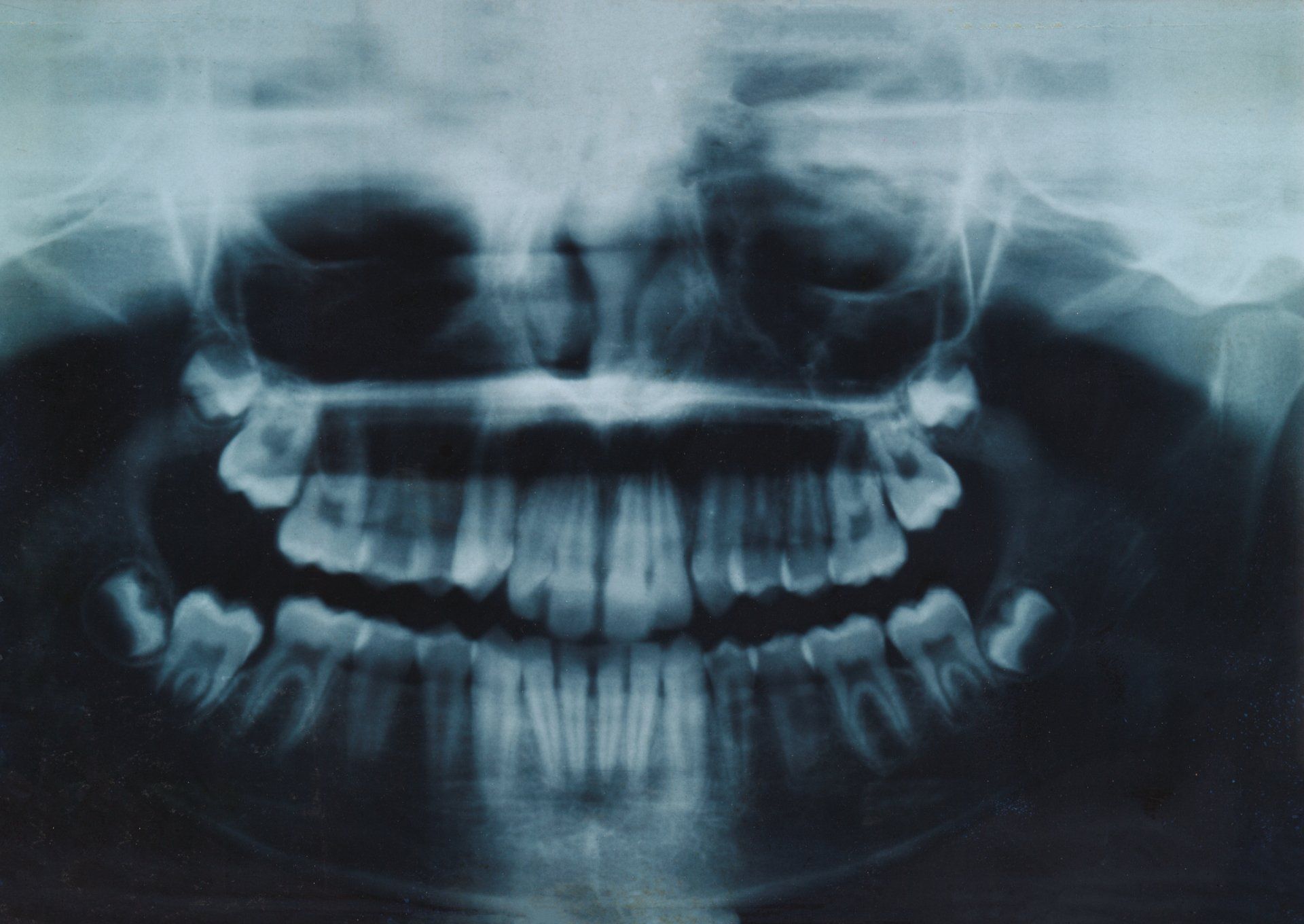 An x-ray of a person 's teeth and skull.