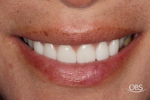 Close-up of a smiling mouth showing a set of white, even teeth. Pink lips surround the teeth.