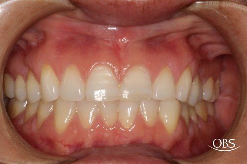 Close-up view of teeth in an open mouth, showing healthy gums and white teeth in good alignment.