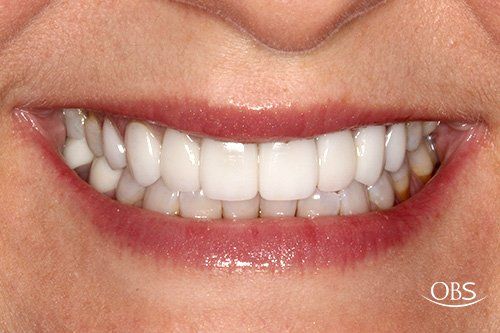 Close-up of a person smiling, revealing bright white, even teeth. Reddish lipstick and healthy gums are visible.