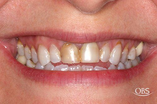 Close-up of teeth with discoloration, especially on central incisors, visible inside the mouth.