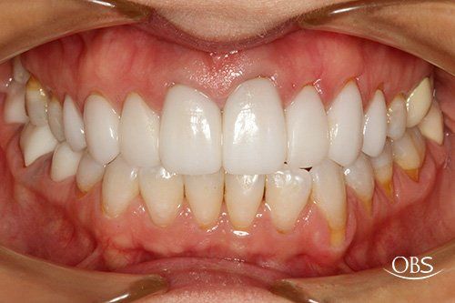 Mouth open, showing teeth. Front teeth are white, other teeth are yellowish. Gums are pink.