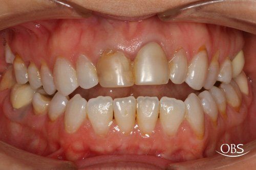 Close-up view of teeth showing discoloration, a crown, and moderate crowding in an oral exam.
