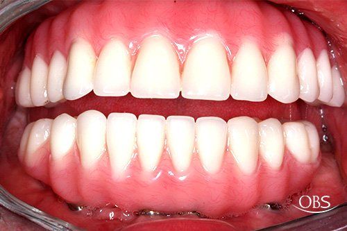 Close-up of a patient's mouth with full dentures in place; pink gums, white teeth.