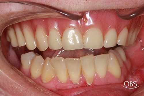 Close-up view of teeth in an open mouth, showing upper and lower teeth; healthy, light-colored teeth.
