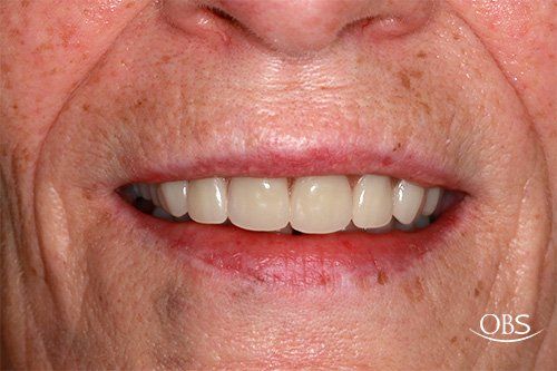 Close-up of a person's smiling mouth showing a complete set of artificial teeth. Red lips, freckled skin.