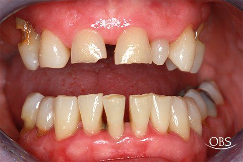 Mouth showing damaged teeth, some chipped and broken, with signs of decay.
