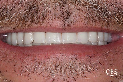 Close-up of a smiling mouth showing a full set of white, even teeth. Beige mustache and beard.