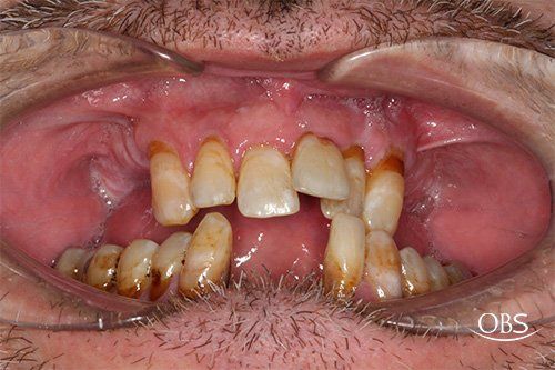 Mouth with severely decayed and discolored teeth; dental retractor in use.