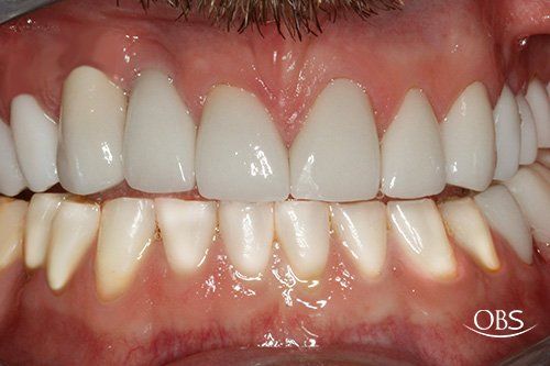 Close-up of teeth with bright white upper teeth and slightly yellow lower teeth. Gums are pink.