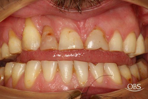 Close-up of a person's mouth showing teeth with visible decay, discoloration, and receding gums.