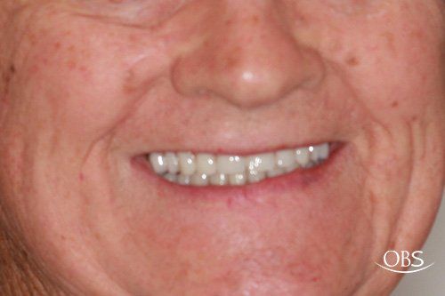 Close-up of a person smiling, showing a full set of teeth and wrinkles.
