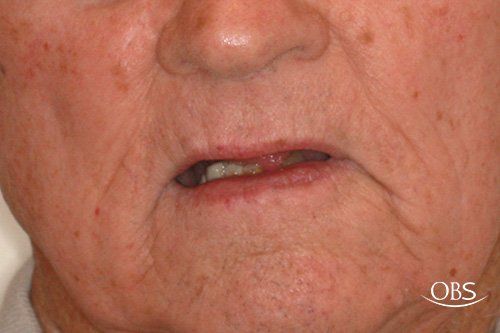 Close-up of a person's mouth and lower face, with asymmetrical mouth and visible teeth, possibly from a condition.
