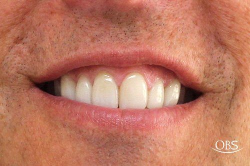 Close-up of a smiling mouth, showing bright white teeth against pink gums and lips.