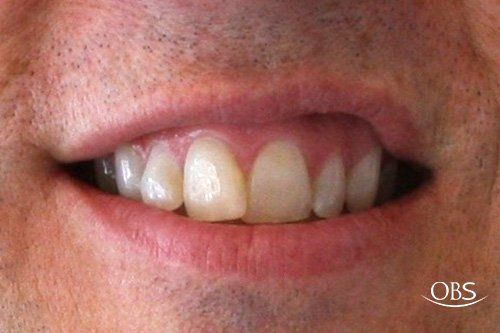 Close-up of a person's teeth and mouth, revealing healthy gums and slightly yellowed teeth.