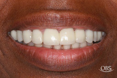 Close-up of a person's bright smile, showing white teeth, and pink gums, with dark skin and lips.