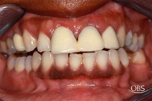 Dental view: upper and lower teeth, two center teeth capped, dark gums visible.