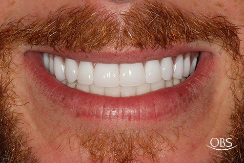 Close-up of a smiling mouth with very white, straight teeth and a red beard.