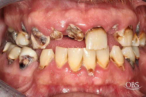 Mouth with severe tooth decay and damage: multiple missing, broken, and discolored teeth.