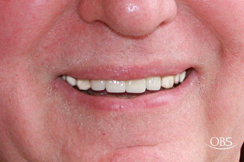 Close-up of a person's smiling mouth showing a row of white, even teeth. Pale skin and pink lips.