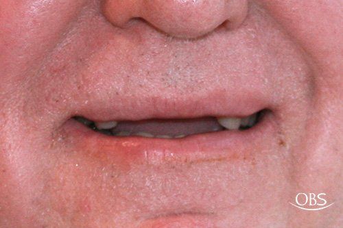 Close-up of a person's mouth with missing bottom teeth and visible upper lip.