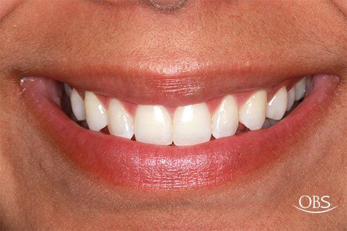 A smiling mouth with bright white teeth and red lipstick.