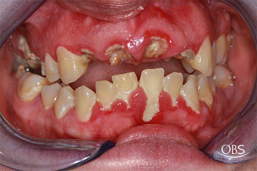 Mouth with severe gum disease, inflamed gums, and decayed teeth.
