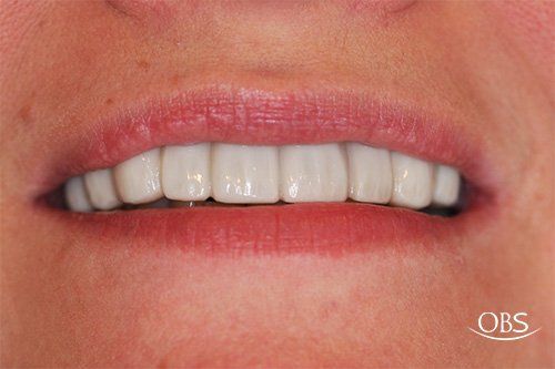 Close-up of a person's smiling mouth showing a row of white, even teeth.