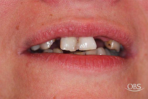 Mouth with several damaged and missing teeth. The remaining teeth are discolored.