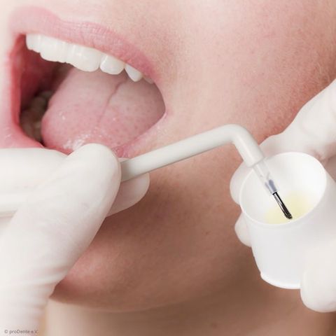 Fluoridierung zur Schmelzhärtung Fluoridierung zur Schmelzhärtung
