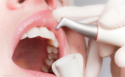 Beseitigung von Zahnbelag mit dem Pulverstrahlgerät Beseitigung von Zahnbelag mit dem Pulverstrahlgerät