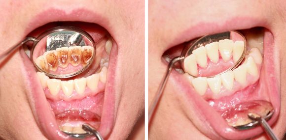 Primi piani affiancati di una bocca aperta con la lingua sollevata, che mostrano i denti e uno specchietto dentale.