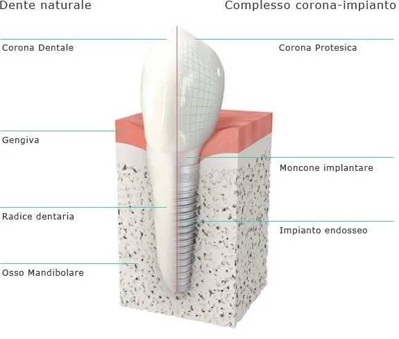 Analogia tra Dente Naturale ed Impianto Endosseo