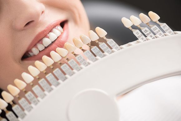 Sbiancamento denti