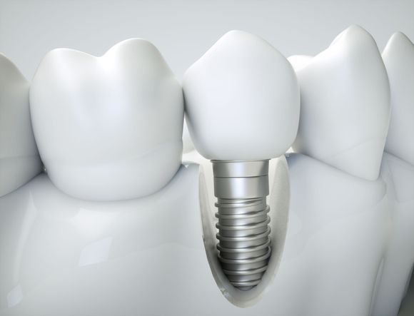 Modello dente sostituito