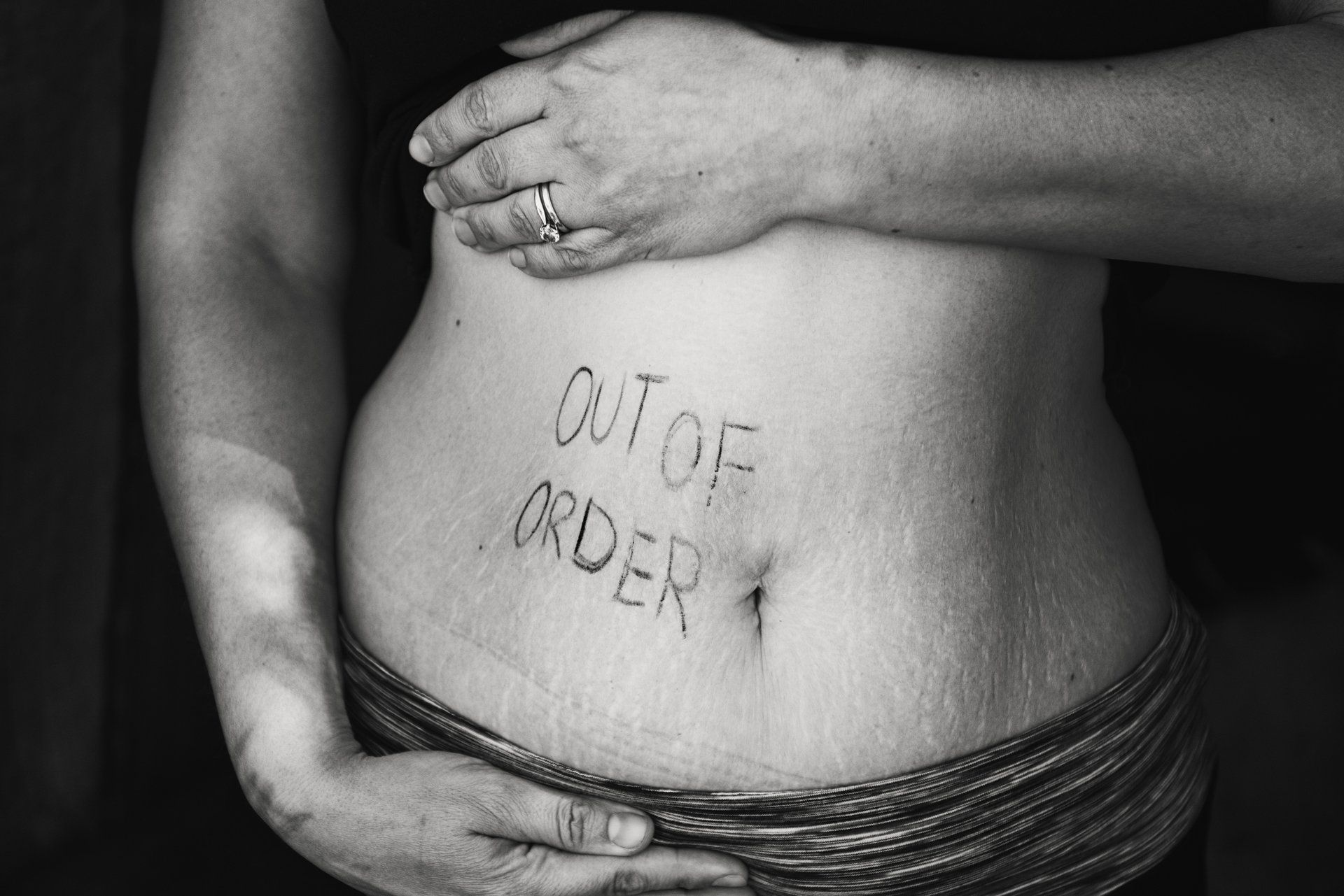 Leaky Gut Syndrome
