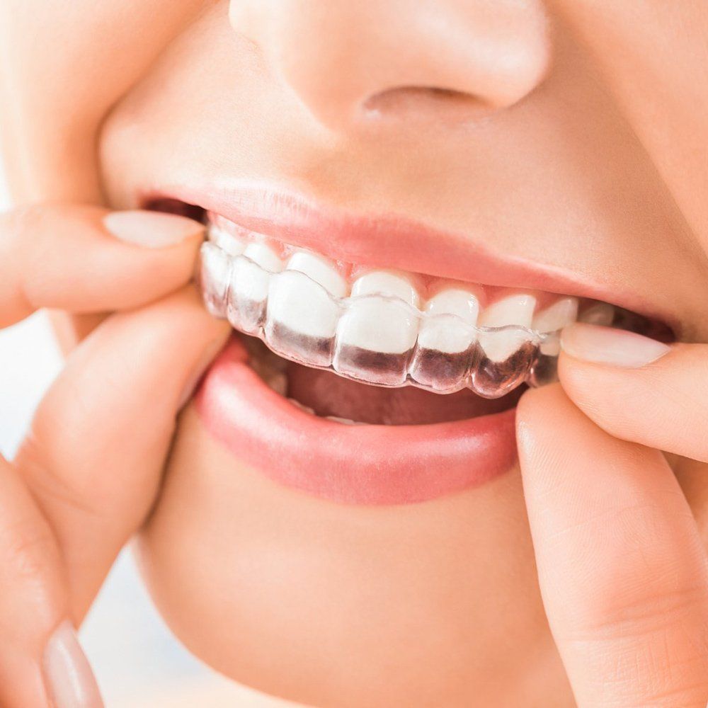 Putting Invisalign Braces — Newburyport, MA — Vaka Dental Care Putting Invisalign Braces — Newburyport, MA — Vaka Dental Care