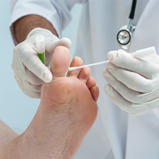 verruca removal by a professional nail care expert