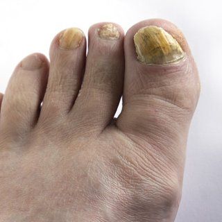 ingrown nails and infection treatment