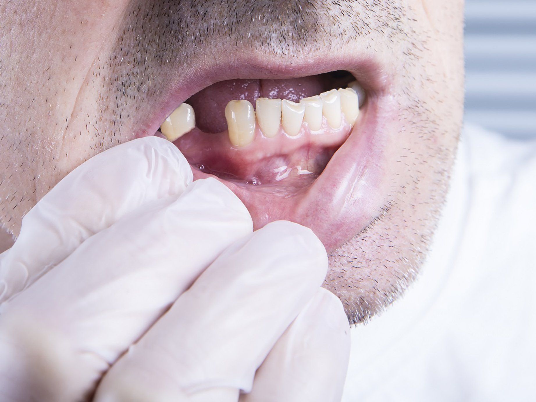 Untreated Missing Tooth