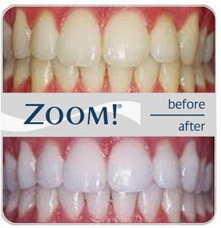 Zoom whitening 2
