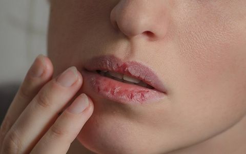 Woman with Dry Lips — Clarkston, MI — Mark Frenchi DDS Woman with Dry Lips — Clarkston, MI — Mark Frenchi DDS