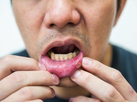 Man with Canker Sore — Clarkston, MI — Mark Frenchi DDS Man with Canker Sore — Clarkston, MI — Mark Frenchi DDS
