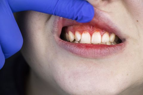 Woman Checking Her Gums and Teeth — Clarkston, MI — Mark Frenchi DDS Woman Checking Her Gums and Teeth — Clarkston, MI — Mark Frenchi DDS
