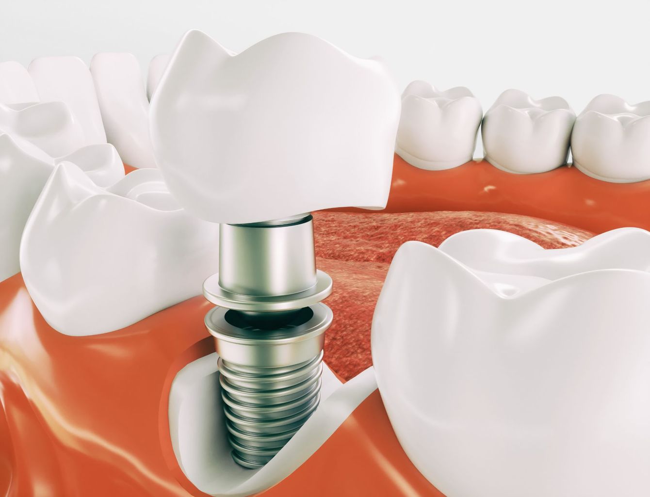 disegno di un dente avvitato in un impianto