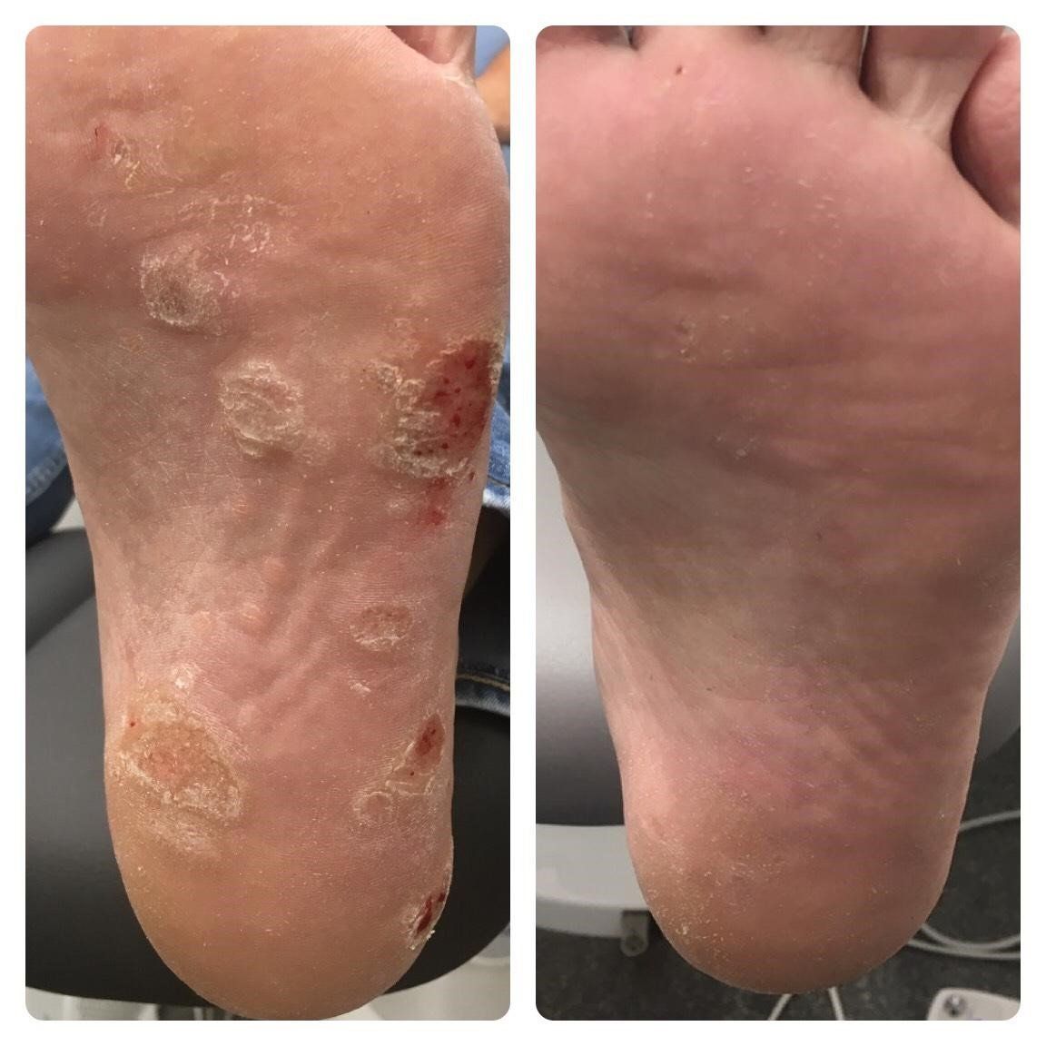 verruca before and after