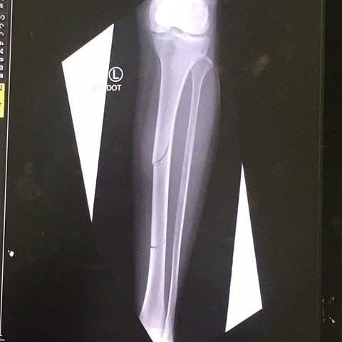 tib/fib fracture xrays